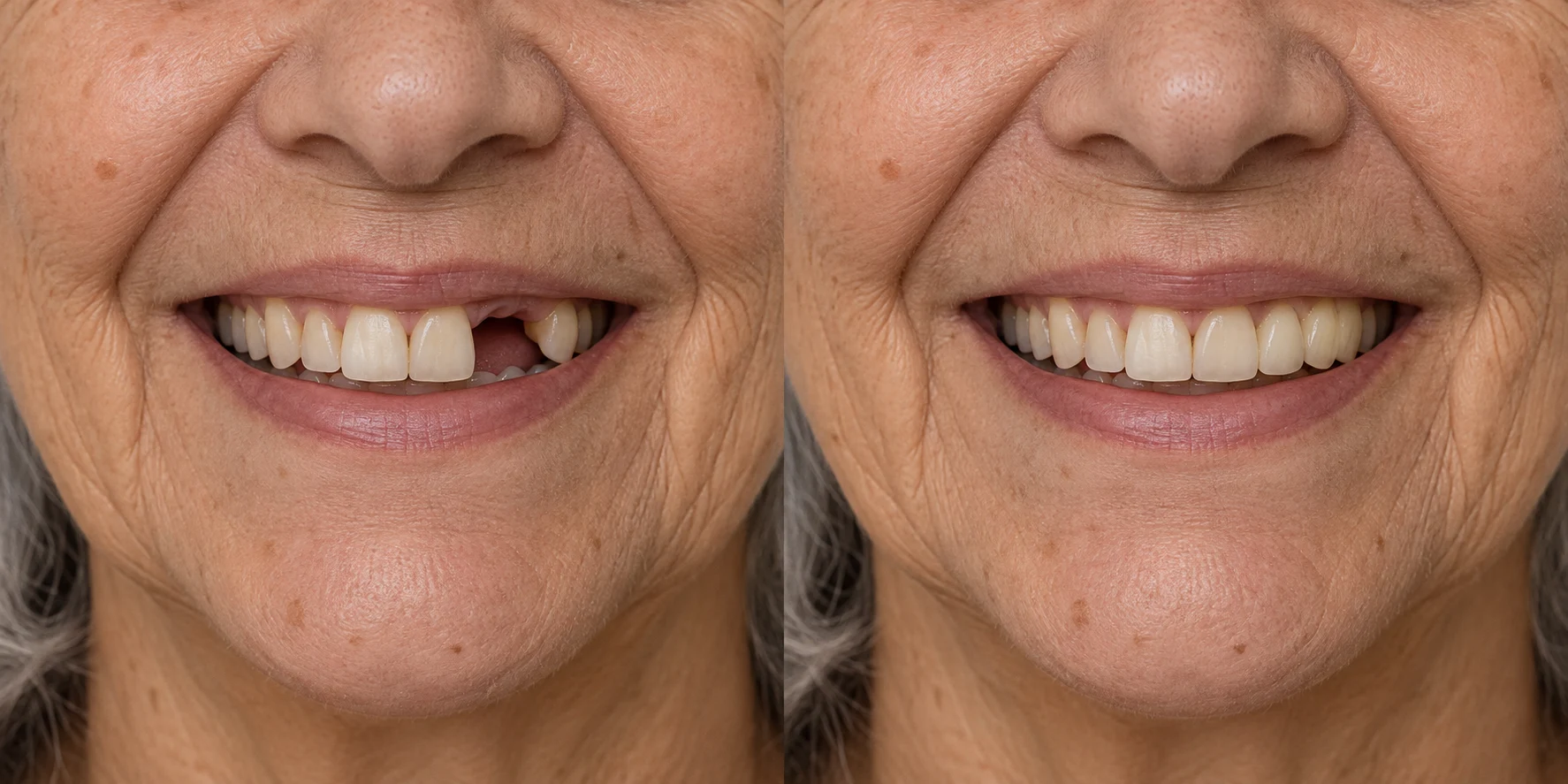 Simulação gerada por IA, com foco na boca de uma senhora: à esquerda, dentes superiores ausentes; à direita, uma versão ilustrativa com reposição dos dentes, preservando as marcas naturais de idade.